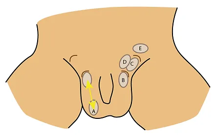 Ectopia Testiculară - Cum Se Diferențiază Ectopia Testiculară Stângă de Ectopia Testiculară Dreaptă?