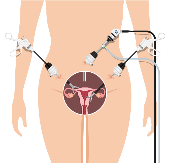 Histerectomia totala: când tot uterul trebuie să plece